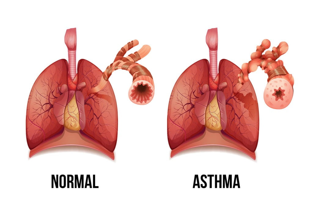 lungs : can smoking with asthma kill you