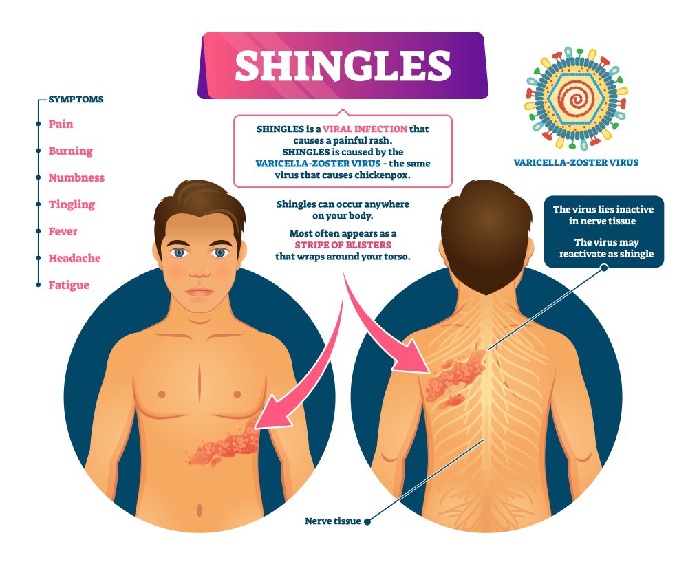stages of shingles